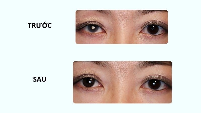 Trước và sau khi sử dụng kính áp tròng thẩm mỹ