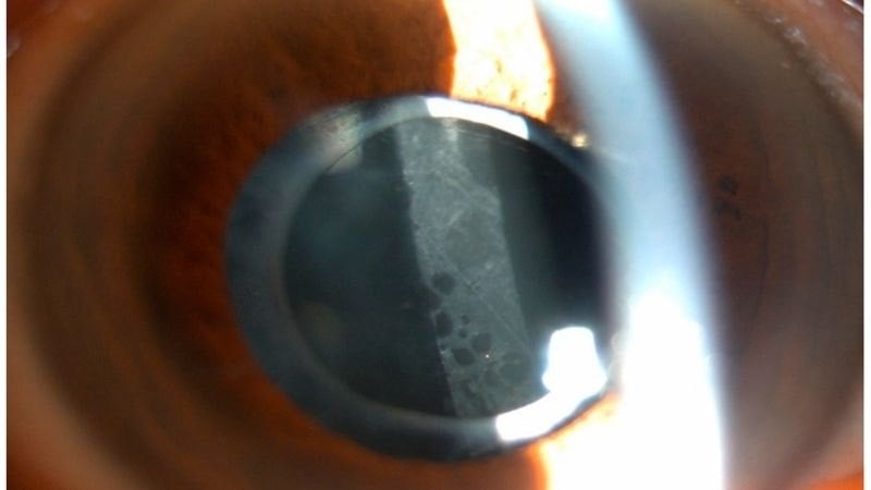 Các tế bào biểu mô còn sót lại có thể tiếp tục phát triển làm cho lớp màng  dần trở nên mờ đục