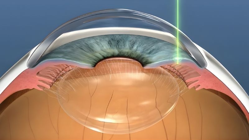 Laser mống mắt chu biên giúp thủy dịch lưu thông dễ dàng