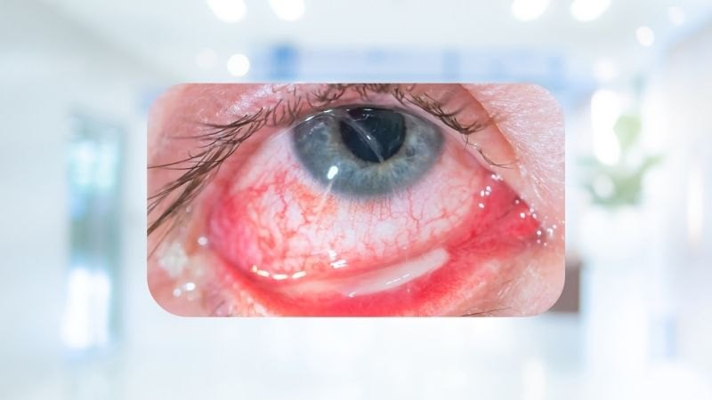 Giả mạc mắt được hình thành do sự tích tụ của tơ huyết và các tế bào viêm trên bề mặt kết mạc