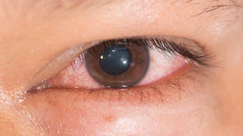 Viêm kết mạc giả mạc gây kích thích mắt sưng nề