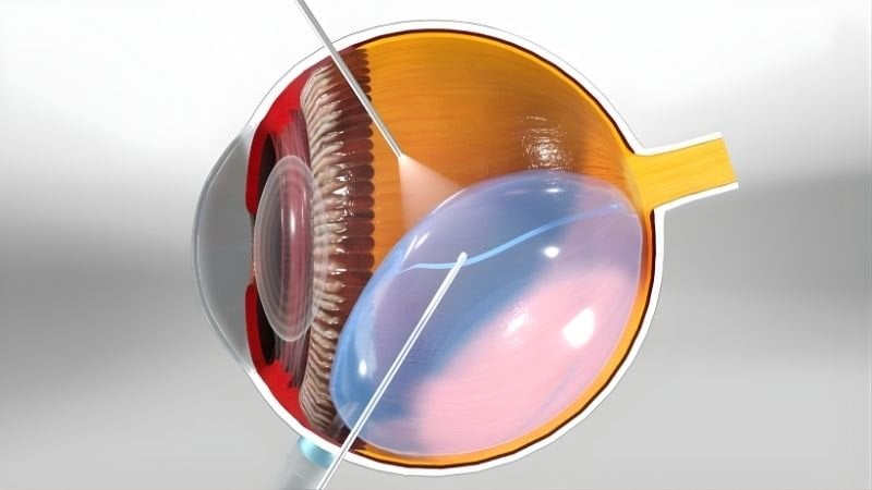 Hình minh họa quá trình bác sĩ đưa dụng cụ vào bên trong mắt để điều trị võng mạc