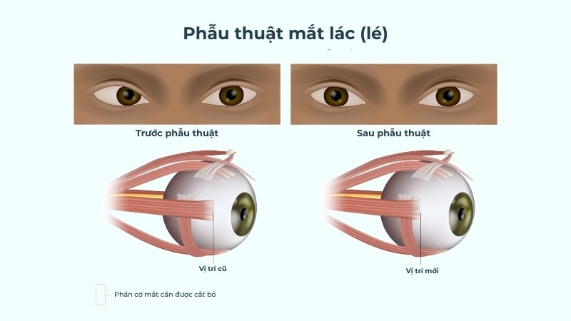 Phẫu Thuật Mắt Lác (Lé): Quy Trình, Chi Phí Và Hướng Dẫn Chăm Sóc Sau Mổ