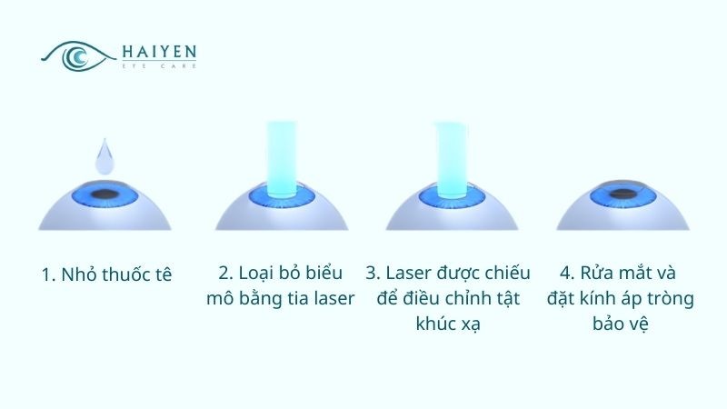 Các bước thực hiện phẫu thuật SmartSurface