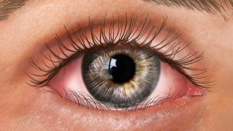 Quặm mi là tình trạng mí mắt hướng vào trong, tạo ma sát giữa lông mi và giác mạc