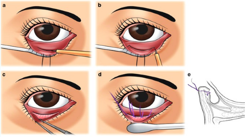 Quy trình cắt da và siết cơ mi