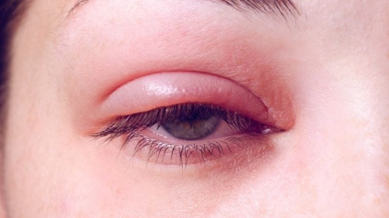 Viêm bờ mi là tình trạng viêm nhiễm mạn tính xảy ra ở vùng rìa mi mắt