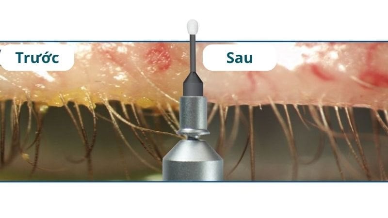 Thủ thuật được thực hiện bởi bác sĩ mắt chuyên khoa tại phòng khám