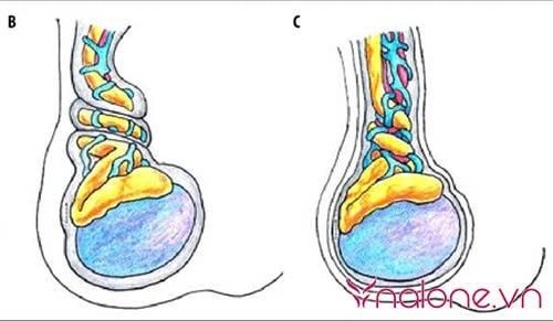 xoắn tinh hoàn có tự khỏi nguyên nhân gây xoắn