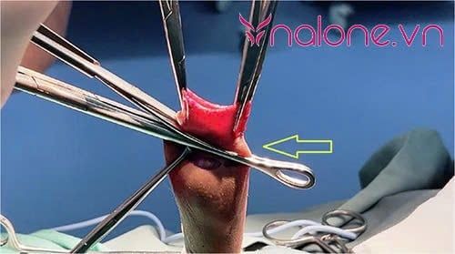 phẫu thuật cắt bao quy đầu có đau không