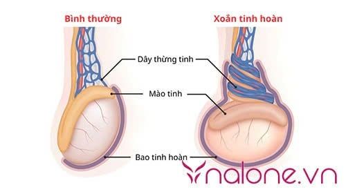 bệnh lý xoắn tinh hoàn có tự khỏi