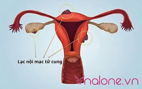 Quan hệ ngày đèn đỏ có bị vô sinh không? nguy cơ viêm tử cung