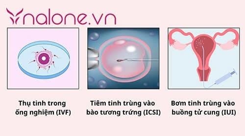 biện pháp hỗ trợ khi bị vô sinh là gì