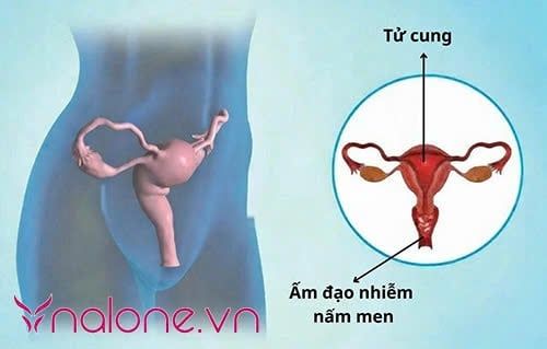 viêm âm đạo và viêm bộ phận sinh dục nữ là gì