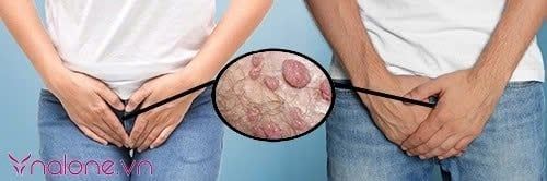 Đeo bao cao su có bị sùi mào gà không?