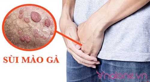 Đeo bao cao su có bị sùi mào gà không?