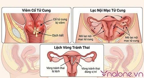 Quan hệ mạnh có ảnh hưởng đến tử cung không?