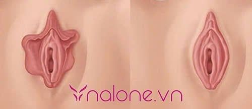 phẫu thuật thu gọ môi bé phì đại là gì