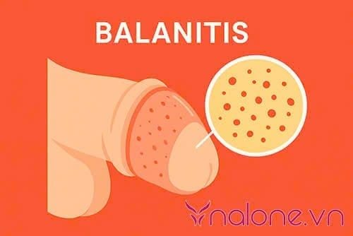 Viêm bao quy đầu có quan hệ được không?