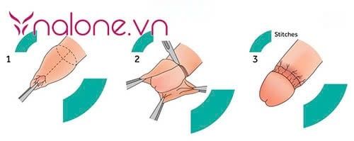 nam giới cắt bao quy đầu có đau không