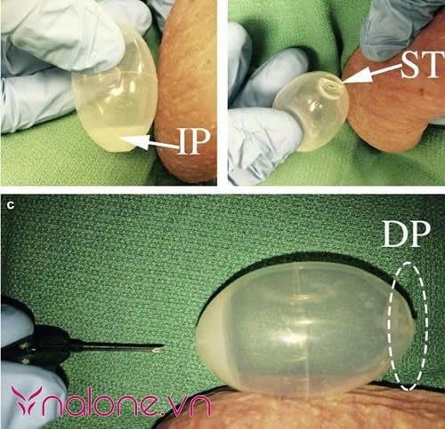 nam giới đặt tinh hoàn nhân tạo là gì