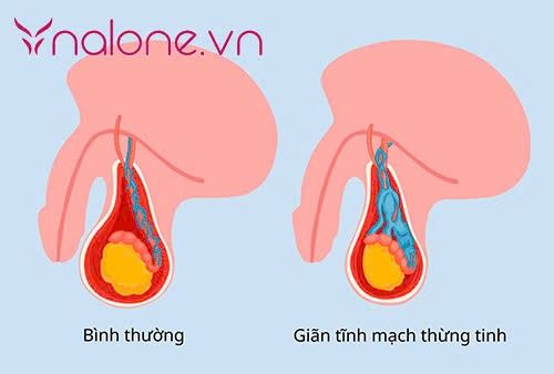 tinh hoàn xệ có bị vô sinh không ảnh hưởng sức khỏe