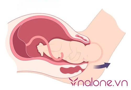 sinh thường làm môi bé phì đại là gì