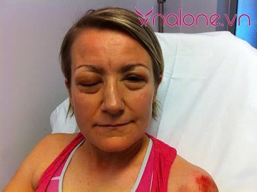 Dấu hiệu dị ứng gel bôi trơn khi sốc phản vệ