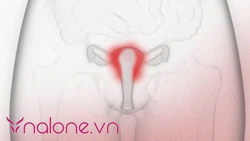 viêm tử cung và viêm bộ phận sinh dục nữ là gì