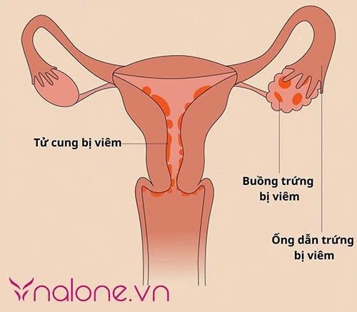 viêm buồng trứng và viêm bộ phận sinh dục nữ là gì