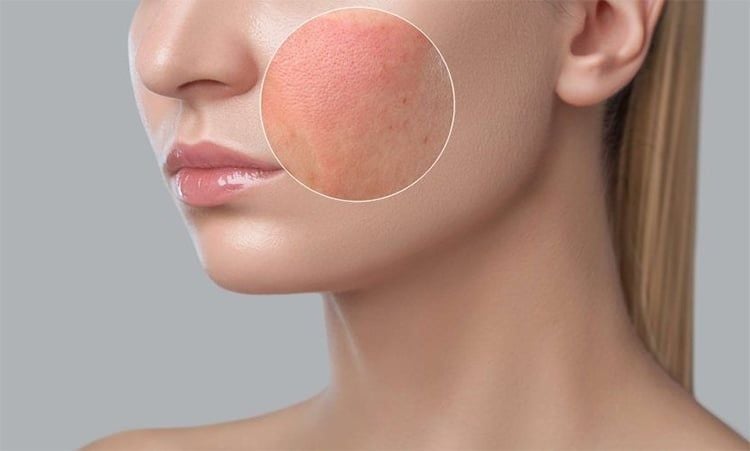 Phản ứng da tạm thời khi sử dụng tinh dầu thông đỏ giai đoạn đầu