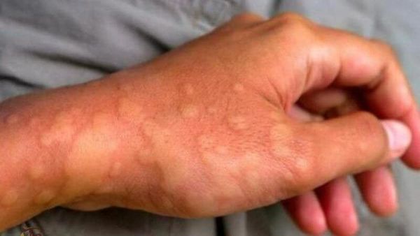 Giới thiệu tổng quan về mề đay mẩn ngứa