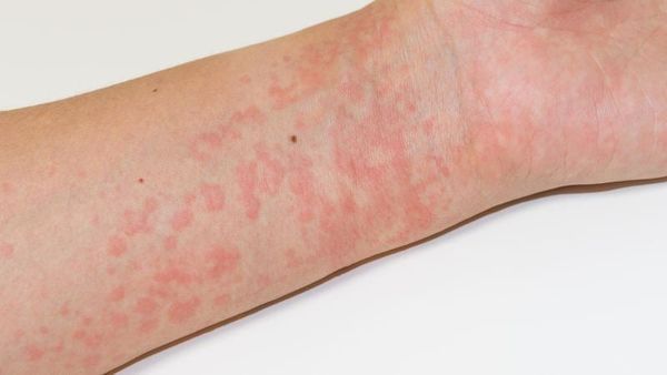 Nguyên nhân gây mề đay mẩn ngứa ở da