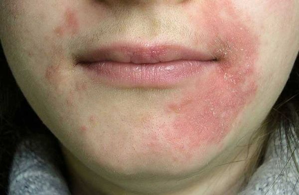 Những trường hợp mề đay nên gặp bác sĩ