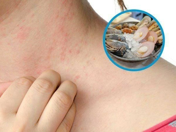 Nguyên nhân dị ứng hải sản phổ biến