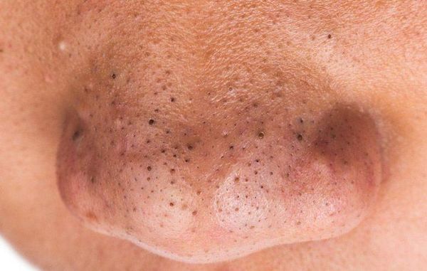 Định nghĩa về mụn đầu đen