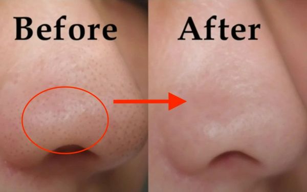 Bao lâu thì tình trạng mụn đầu đen sẽ cải thiện