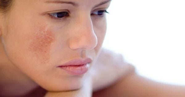 làm đẹp da thâm nám sau sinh