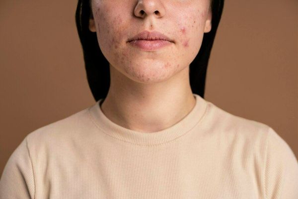 Mụn nội tiết (hormonal acne)