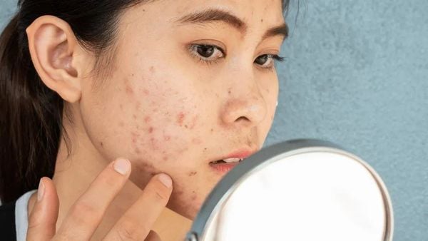 Những sai lầm cần tránh khi điều trị mụn nội tiết