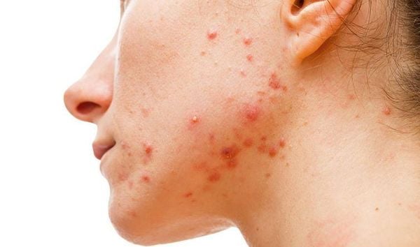 4 dấu hiệu mụn nội tiết đặc trưng nhất