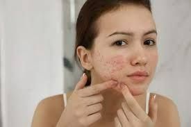 Càng skincare da càng nổi mụn – có phải chuyện hiếm