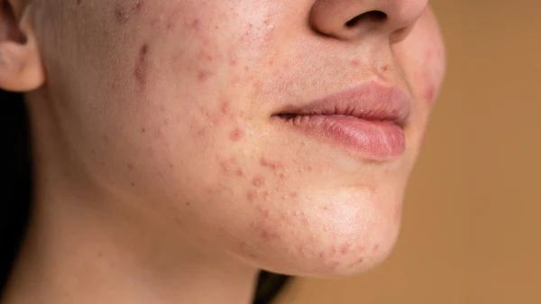 Skincare thế nào để da mụn cải thiện thật sự
