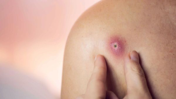 Hướng dẫn xử lý mụn đúng cách và an toàn