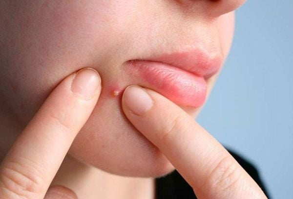Những sai lầm phổ biến cần tránh khi trị mụn nhọt