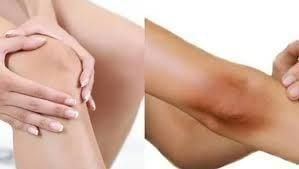 Những rủi ro tiềm ẩn khi trị thâm bằng kem đánh răng và chanh
