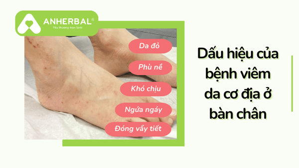 dau hieu viem da co dia o ban chan