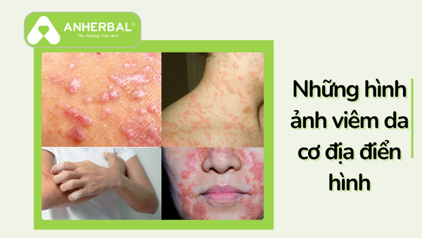những hình ảnh viêm da cơ địa điển hình