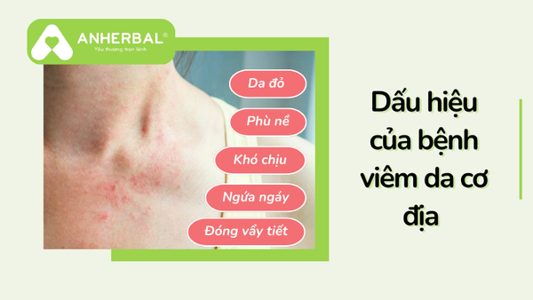 dấu hiệu của bệnh viêm da cơ địa
