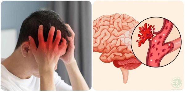 cách kiểm soát nguy cơ đột quỵ thứ phát hiệu quả